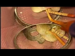 সানি ট্রিটমেন্ট কেস